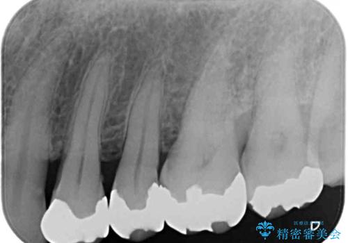 銀歯を白くしたい　セラミックによる審美歯科治療の治療前