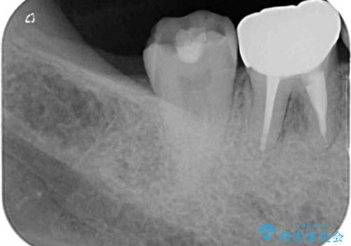 奥歯の歯茎から膿が出る 根管治療とオールセラミッククラウンの治療後
