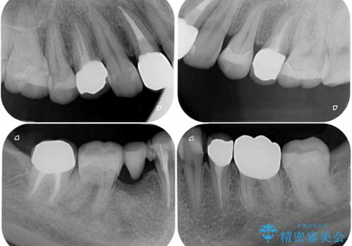 金属の見えてしまったクラウン セラミッククラウンで自然にの治療後
