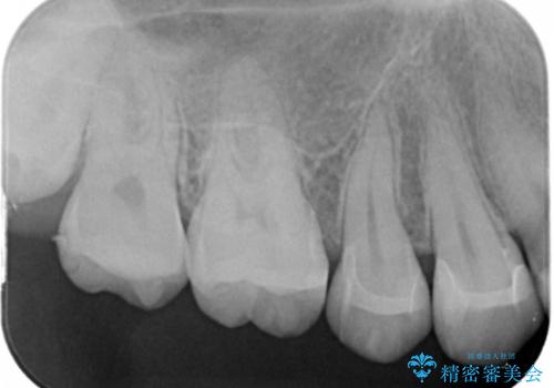 セラミック治療の治療後