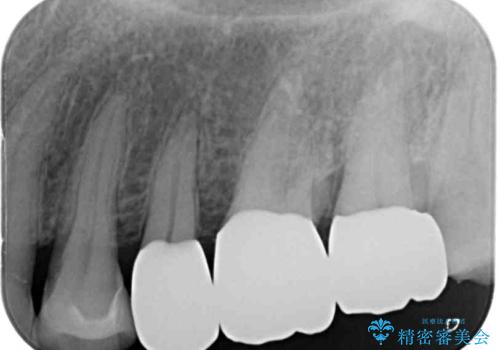銀歯を白くしたい セラミックによる審美歯科治療の治療後