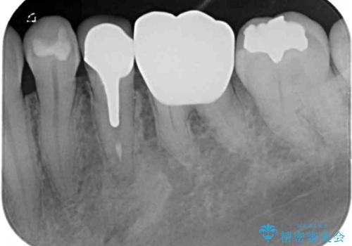 銀歯を白くしたい セラミックによる審美歯科治療の治療後