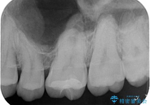 奥歯に隠れた虫歯 セラミックインレーでの修復の治療後