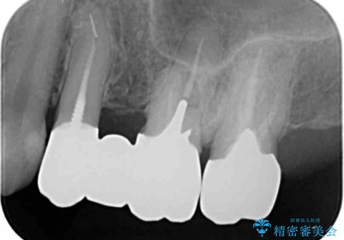 銀歯を白くしたい セラミックブリッジでの治療の治療後