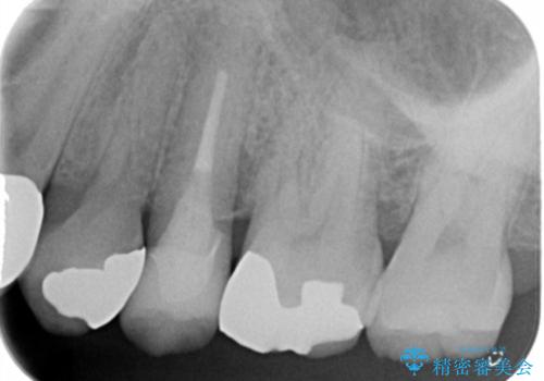 銀の詰め物をやりかえたいの治療前