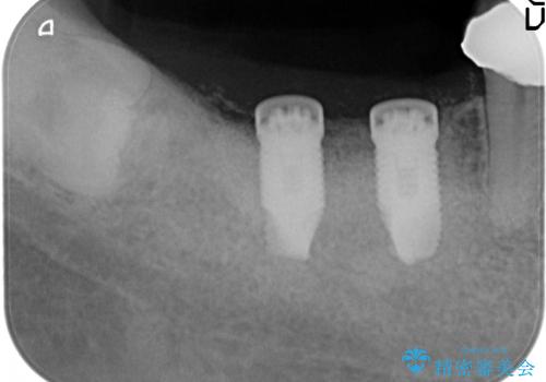 臼歯部インプラント治療の治療中
