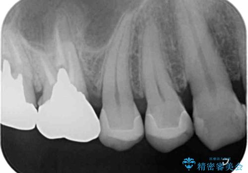外から見える銀歯 セラミックでのやり替えの治療後