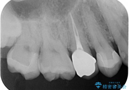 放置していた虫歯 セラミックインレーによる治療の治療後