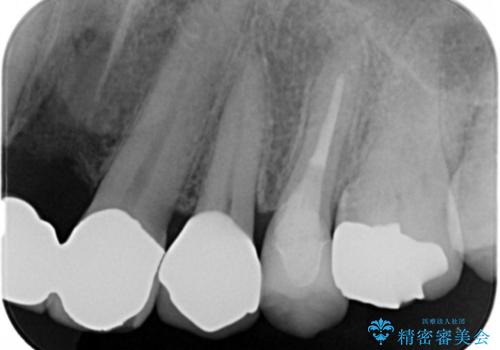 銀の詰め物をやりかえたいの治療後