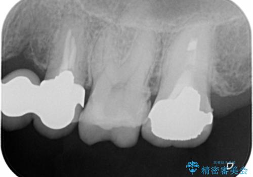 時々しみる奥歯 適合の悪いインレーからクラウンへのやり替えの治療前