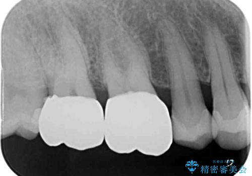 銀歯を白くしたい セラミックによる審美歯科治療の治療後
