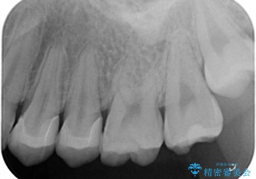 セラミックインレーによる治療の治療後