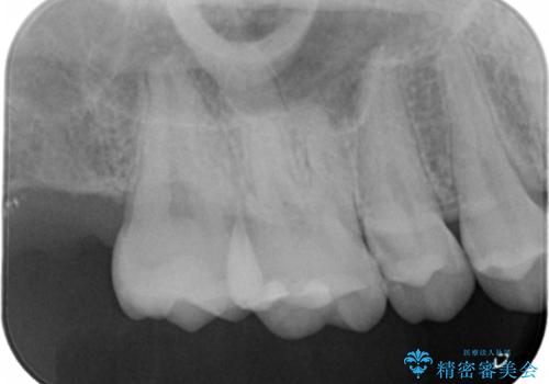 検査で見つかった虫歯 セラミックインレーでの治療の治療前