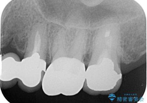 時々しみる奥歯 適合の悪いインレーからクラウンへのやり替えの治療後