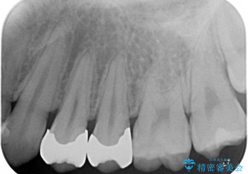 セラミックインレーによる治療の治療前