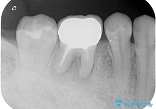 奥歯の歯茎から膿が出る 根管治療とオールセラミッククラウンの治療前