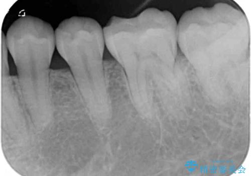 左下の奥歯が冷たいものがしみてザラザラする ゴールドインレー修復 の治療前