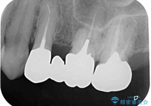 銀歯を白くしたい セラミックブリッジでの治療の治療前