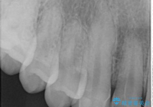穴が開いた前歯 白いクラウンで修復の治療前