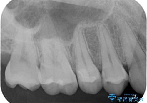 検査で見つかった虫歯 セラミックインレーでの治療の治療後