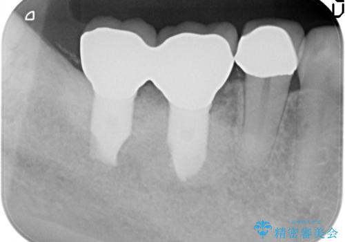 臼歯部インプラント治療の治療後