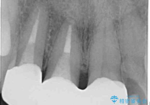前歯のすき間 以前よりも広がってきた 二度と広がらないようにしたい セラミック治療の治療後