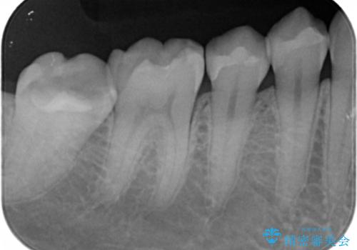 検査で見つかった虫歯　セラミックインレーでの修復の治療後