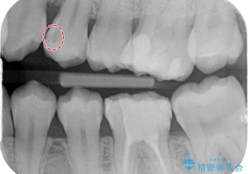 奥歯の虫歯 セラミックインレーによる治療