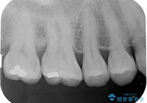 奥歯の虫歯 セラミックインレーによる治療の治療前
