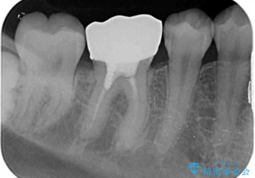 銀歯のやり替え　セラミックで白い歯にの治療前