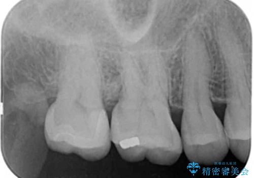 奥歯の虫歯 セラミックインレーによる治療の治療後