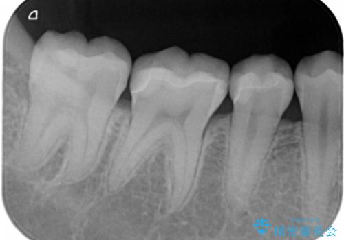 隠れているむし歯 セラミックインレーによる治療の治療後