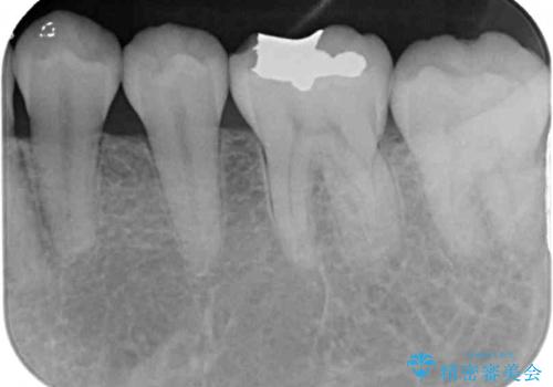 左下の奥歯が冷たいものがしみてザラザラする　ゴールドインレー修復　の治療後