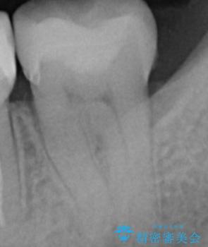 銀を白くしたいの治療後