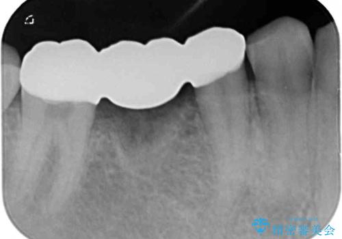 放置した虫歯 奥歯のオールセラミックブリッジ治療の治療後