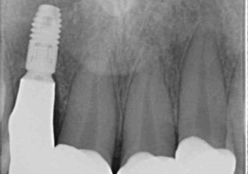前歯の虫歯　オールセラミック治療の治療後