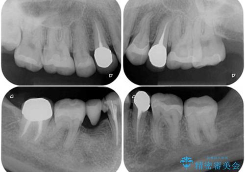 金属の見えてしまったクラウン セラミッククラウンで自然にの治療前