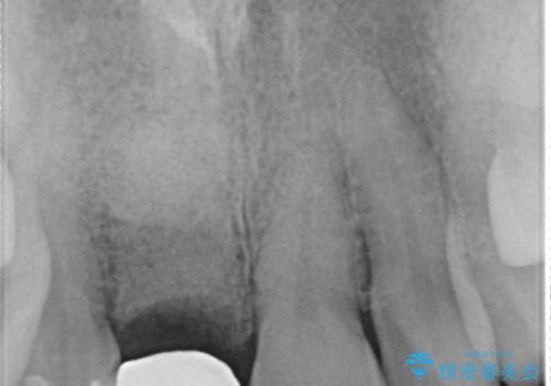 骨造成を伴う前歯のインプラント治療の治療前