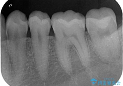治療途中で放置した奥歯 セラミックインレーでの修復の治療後