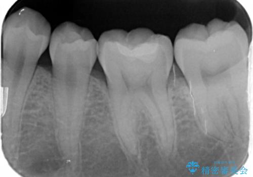歯が黒いのが気になるの治療後