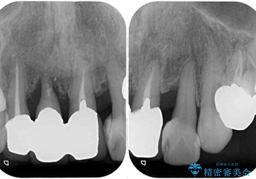 不具合ばかりの前歯　前歯のオールセラミックブリッジの治療前