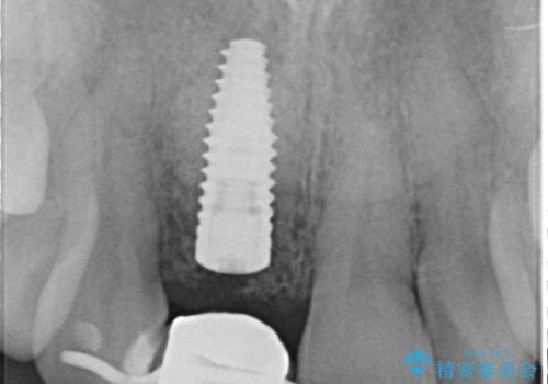 骨造成を伴う前歯のインプラント治療の治療中