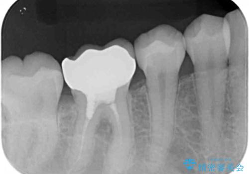 銀歯のやり替え セラミックで白い歯にの治療後