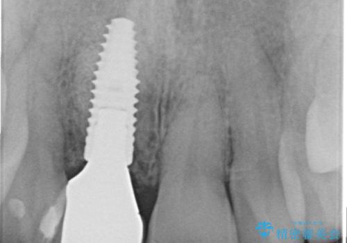 骨造成を伴う前歯のインプラント治療の治療後