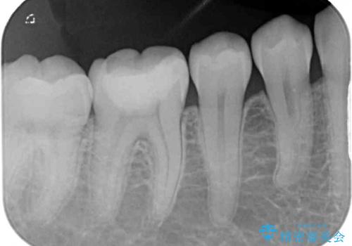 むし歯治療した歯にセラミックを入れたい セラミックインレー修復の治療前