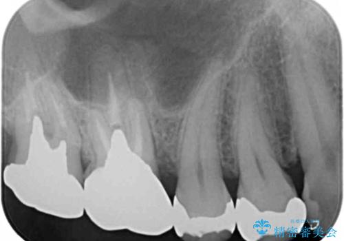 外から見える銀歯 セラミックでのやり替えの治療前