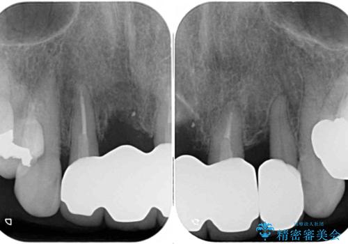 不具合ばかりの前歯 前歯のオールセラミックブリッジの治療後
