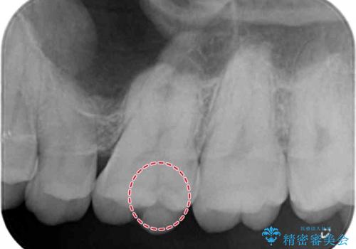 奥歯に隠れた虫歯　セラミックインレーでの修復の治療前