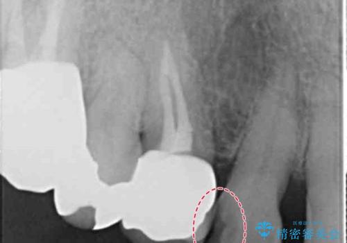 大きい虫歯で欠けた前歯 セラミッククラウンで治療の治療前