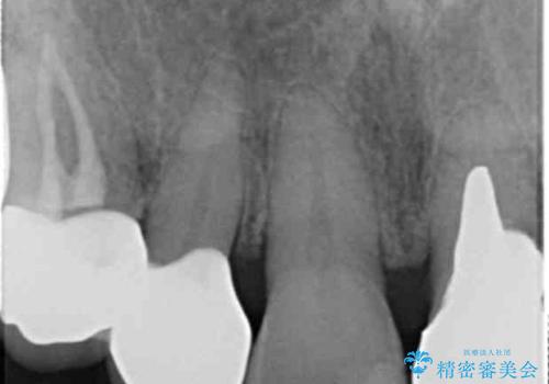 大きい虫歯で欠けた前歯 セラミッククラウンで治療の治療後